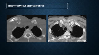 STERNO-CLAVICLE DISLOCATION: CT
 