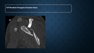 CT Needed if Scapula Fracture Seen
 
