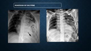 POSITION OF NG TUBE
 