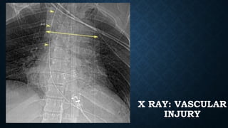 X RAY: VASCULAR
INJURY
 