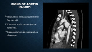 SIGNS OF AORTIC
INJURY:
Intraluminal filling defect (intimal
flap or clot)
Abnormal aortic contour (mural
hematoma)
Pseudoaneurysm & extravasation
of contrast
 