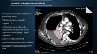 TRAUMATIC ESOPHAGEAL RUPTURE
• Can occur secondary to both blunt or
penetrating trauma.
• CT is the preferred modality.
• Signs on CT:
• extraluminal gas locules in the
mediastinum or abdominal cavity,
adjacent to the esophagus: highly
suggestive.
• pleural or mediastinal fluid.
• pneumomediastinum or pneumothorax.
• pericardial or pleural effusions can be
seen.
 