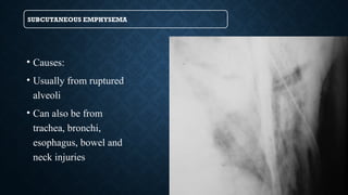 SUBCUTANEOUS EMPHYSEMA
• Causes:
• Usually from ruptured
alveoli
• Can also be from
trachea, bronchi,
esophagus, bowel and
neck injuries
 