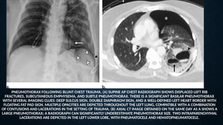 PNEUMOTHORAX FOLLOWING BLUNT CHEST TRAUMA. (A) SUPINE AP CHEST RADIOGRAPH SHOWS DISPLACED LEFT RIB
FRACTURES, SUBCUTANEOUS EMPHYSEMA, AND SUBTLE PNEUMOTHORAX. THERE IS A SIGNIFICANT BASILAR PNEUMOTHORAX
WITH SEVERAL IMAGING CLUES: DEEP SULCUS SIGN, DOUBLE DIAPHRAGM SIGN, AND A WELL-DEFINED LEFT HEART BORDER WITH
FLOATING FAT PAD SIGN. MULTIPLE OPACITIES ARE DEPICTED THROUGHOUT THE LEFT LUNG, COMPATIBLE WITH A COMBINATION
OF CONTUSIONS AND LACERATIONS IN THE SETTING OF TRAUMA. (B) AXIAL CT IMAGE OBTAINED ON THE SAME DAY AS A SHOWS A
LARGE PNEUMOTHORAX; A RADIOGRAPH CAN SIGNIFICANTLY UNDERESTIMATE PNEUMOTHORAX SIZE. TWO INTRAPARENCHYMAL
LACERATIONS ARE DEPICTED IN THE LEFT LOWER LOBE, WITH PNEUMATOCELE AND HEMATOPNEUMATOCELE.
 