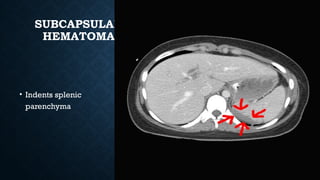 SUBCAPSULAR
HEMATOMA
• Indents splenic
parenchyma
 