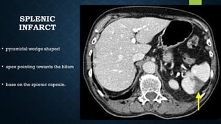 SPLENIC
INFARCT
• pyramidal wedge shaped
• apex pointing towards the hilum
• base on the splenic capsule.
 
