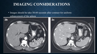 IMAGING CONSIDERATIONS
• Images should be take 50-60 seconds after contrast for uniform
enhancement of the spleen
 