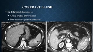 CONTRAST BLUSH
• The differential diagnosis is:
• Active arterial extravasation
• Post-traumatic pseudo-aneurysm
• Post-traumatic AV fistula
 