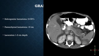GRADE II
• Subcapsular hematoma 10-50%
• Parenchymal hematoma <5 cm
• Laceration 1-3 cm depth
 