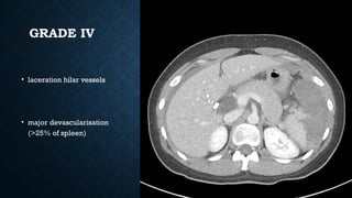 GRADE IV
• laceration hilar vessels
• major devascularisation
(>25% of spleen)
 