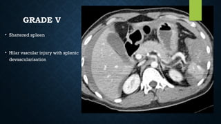 GRADE V
• Shattered spleen
• Hilar vascular injury with splenic
devascularisation
 