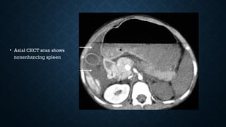 • Axial CECT scan shows
nonenhancing spleen
 