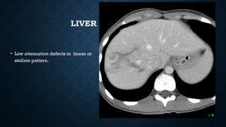 LIVER LACERATION
• Low attenuation defects in linear or
stellate pattern.
 