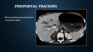 PERIPORTAL TRACKING
• Blood tracking along periportal
connective tissue
 