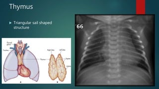 Triangular Sign Chest Thoracic anatomy on various imaging modalities | PPTX