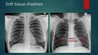 Thoracic anatomy on various imaging modalities | PPTX
