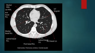 Thoracic anatomy on various imaging modalities | PPTX