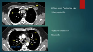 Thoracic anatomy on various imaging modalities | PPTX