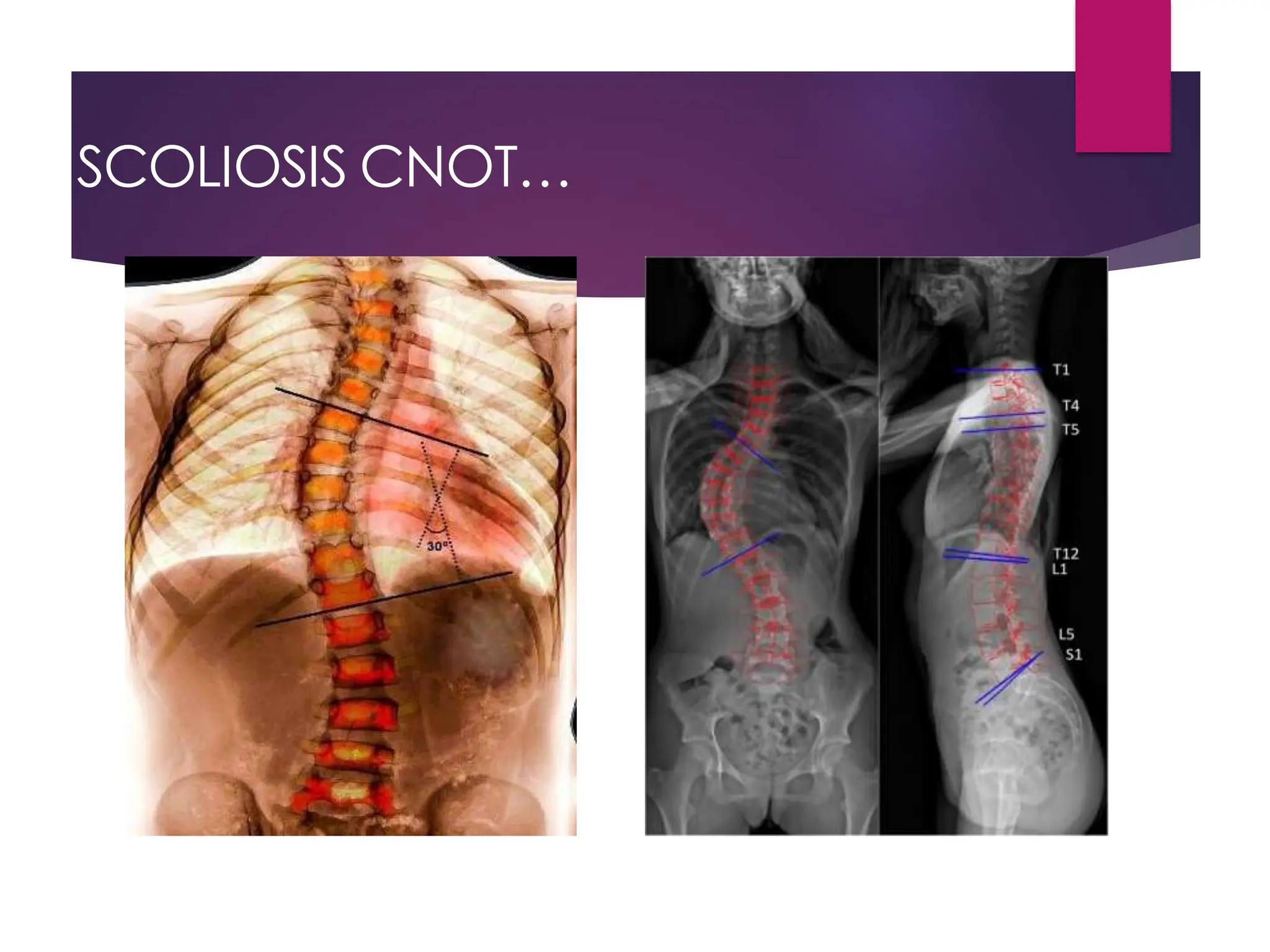 SCOLIOSIS CNOT…
 