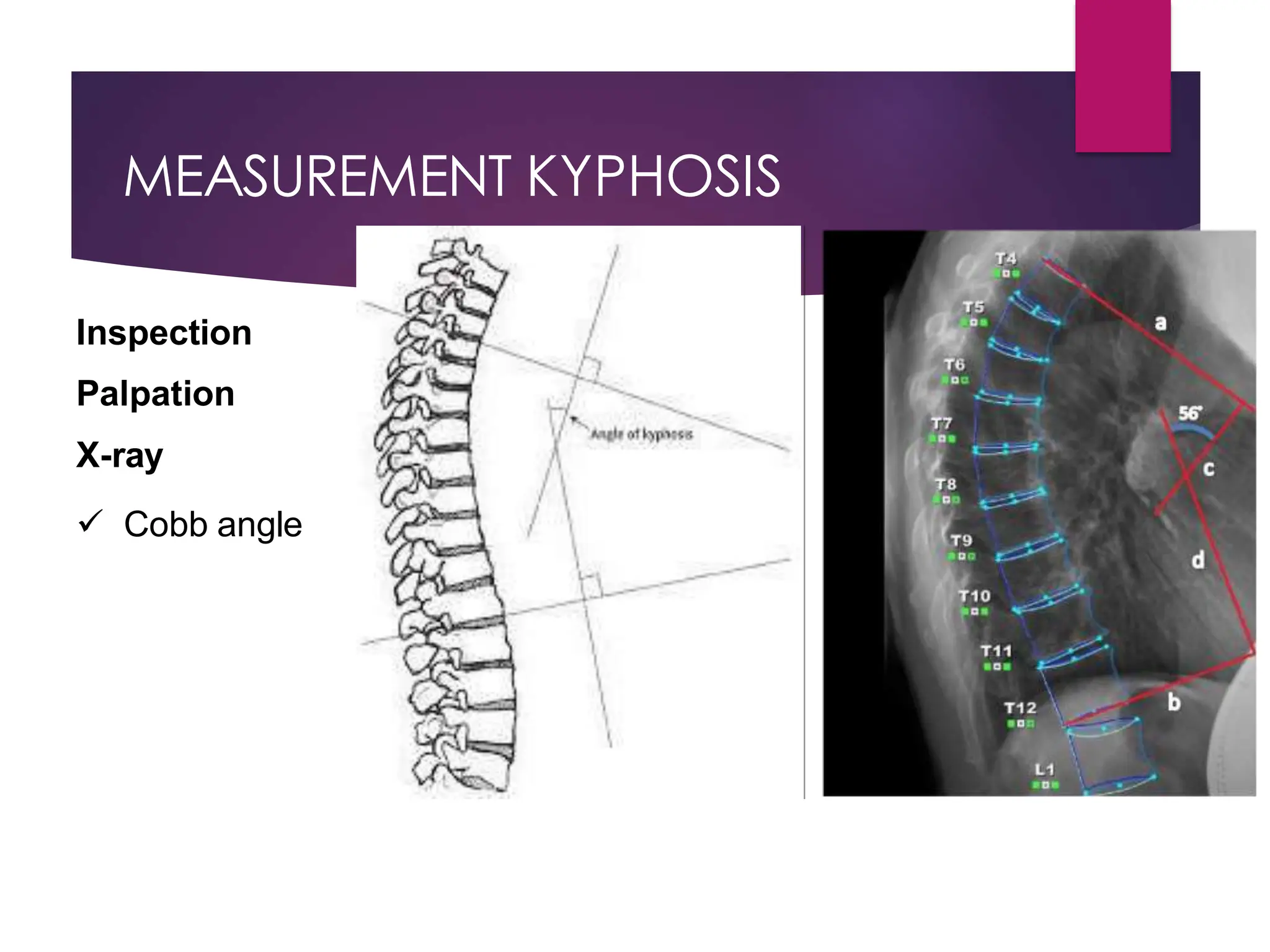 MEASUREMENT KYPHOSIS
Inspection
Palpation
X-ray
 Cobb angle
 