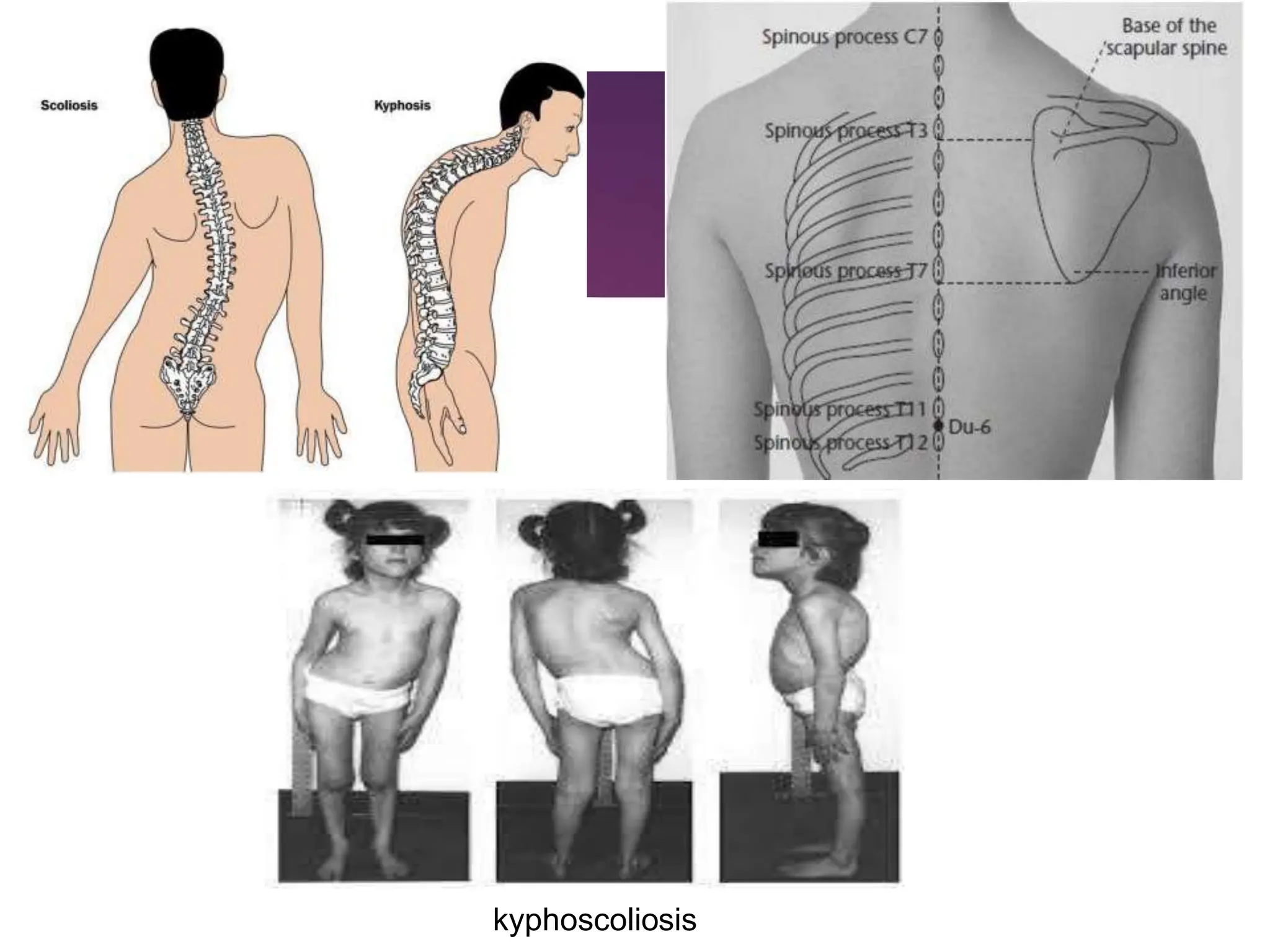 kyphoscoliosis
 