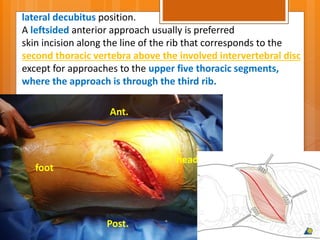 head
foot
Ant.
lateral decubitus position.
A leftsided anterior approach usually is preferred
skin incision along the line of the rib that corresponds to the
second thoracic vertebra above the involved intervertebral disc
except for approaches to the upper five thoracic segments,
where the approach is through the third rib.
Post.
 