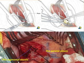 The segmental vessels
The parietal pleura
 