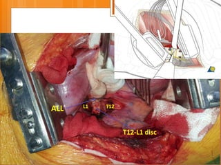 T12-L1 disc
ALL L1 T12
 