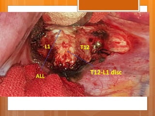 T12-L1 disc
ALL
L1 T12
 
