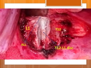 T12-L1 disc
ALL
L1 T12
 