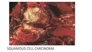 SQUAMOUS CELL CARCINOMA
 