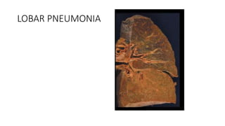 LOBAR PNEUMONIA
 