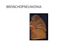 BRONCHOPNEUMONIA
 