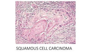 SQUAMOUS CELL CARCINOMA
 