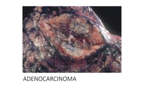 ADENOCARCINOMA
 