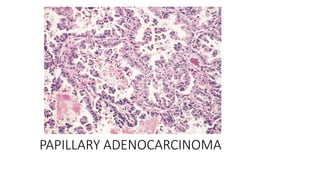 PAPILLARY ADENOCARCINOMA
 