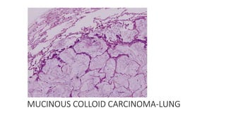 MUCINOUS COLLOID CARCINOMA-LUNG
 