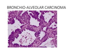 BRONCHIO-ALVEOLAR CARCINOMA
 