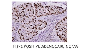 TTF-1 POSITIVE ADENOCARCINOMA
 