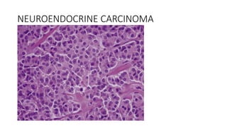 NEUROENDOCRINE CARCINOMA
 