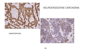 NEUROENDOCRINE CARCINOMA
SYNAPTOPHYSIN
CK
 