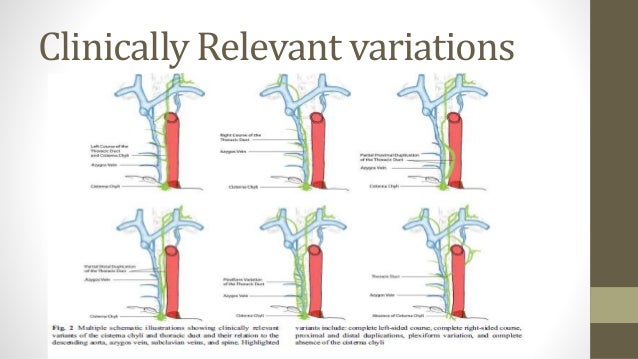 Thoracic duct injury in neck dissection