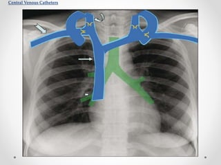 Thoracic imaging in icu | PPTX