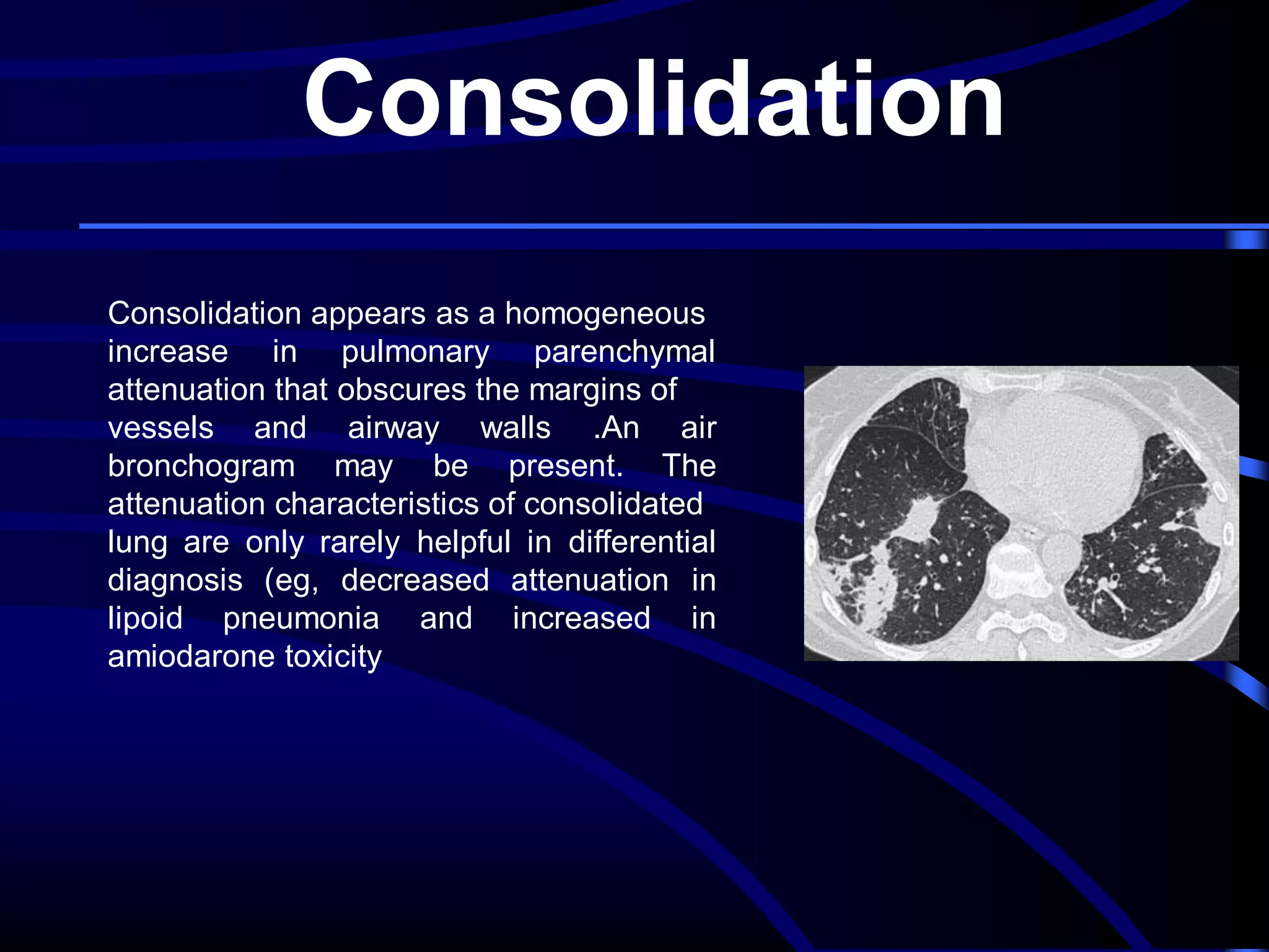 Consolidation
Consolidation appears as a homogeneous
increase in pulmonary parenchymal
attenuation that obscures the margins of
vessels and airway walls .An air
bronchogram may be present. The
attenuation characteristics of consolidated
lung are only rarely helpful in differential
diagnosis (eg, decreased attenuation in
lipoid pneumonia and increased in
amiodarone toxicity

 