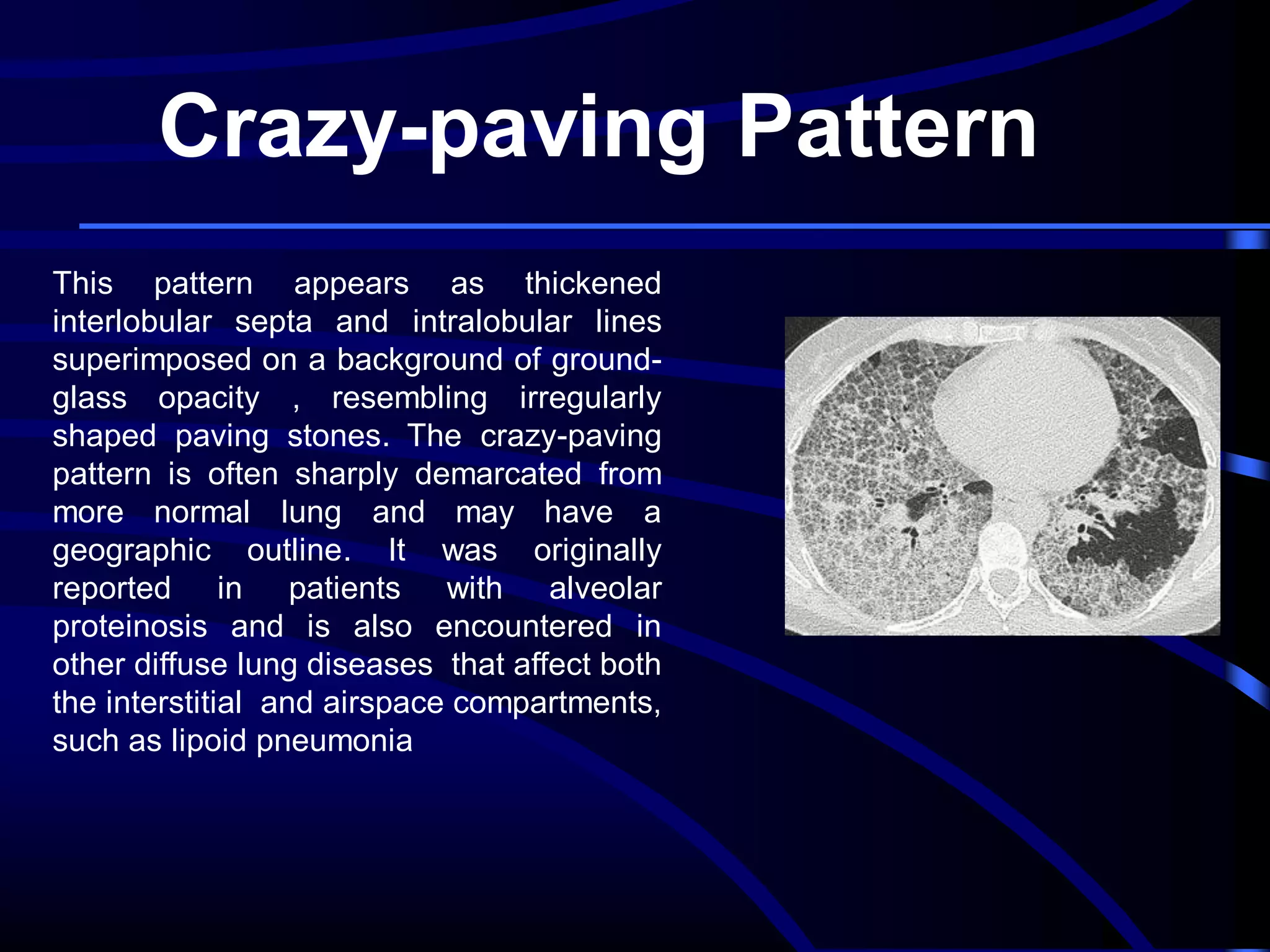 Crazy-paving Pattern
This pattern appears as thickened
interlobular septa and intralobular lines
superimposed on a background of groundglass opacity , resembling irregularly
shaped paving stones. The crazy-paving
pattern is often sharply demarcated from
more normal lung and may have a
geographic outline. It was originally
reported in patients with alveolar
proteinosis and is also encountered in
other diffuse lung diseases that affect both
the interstitial and airspace compartments,
such as lipoid pneumonia

 