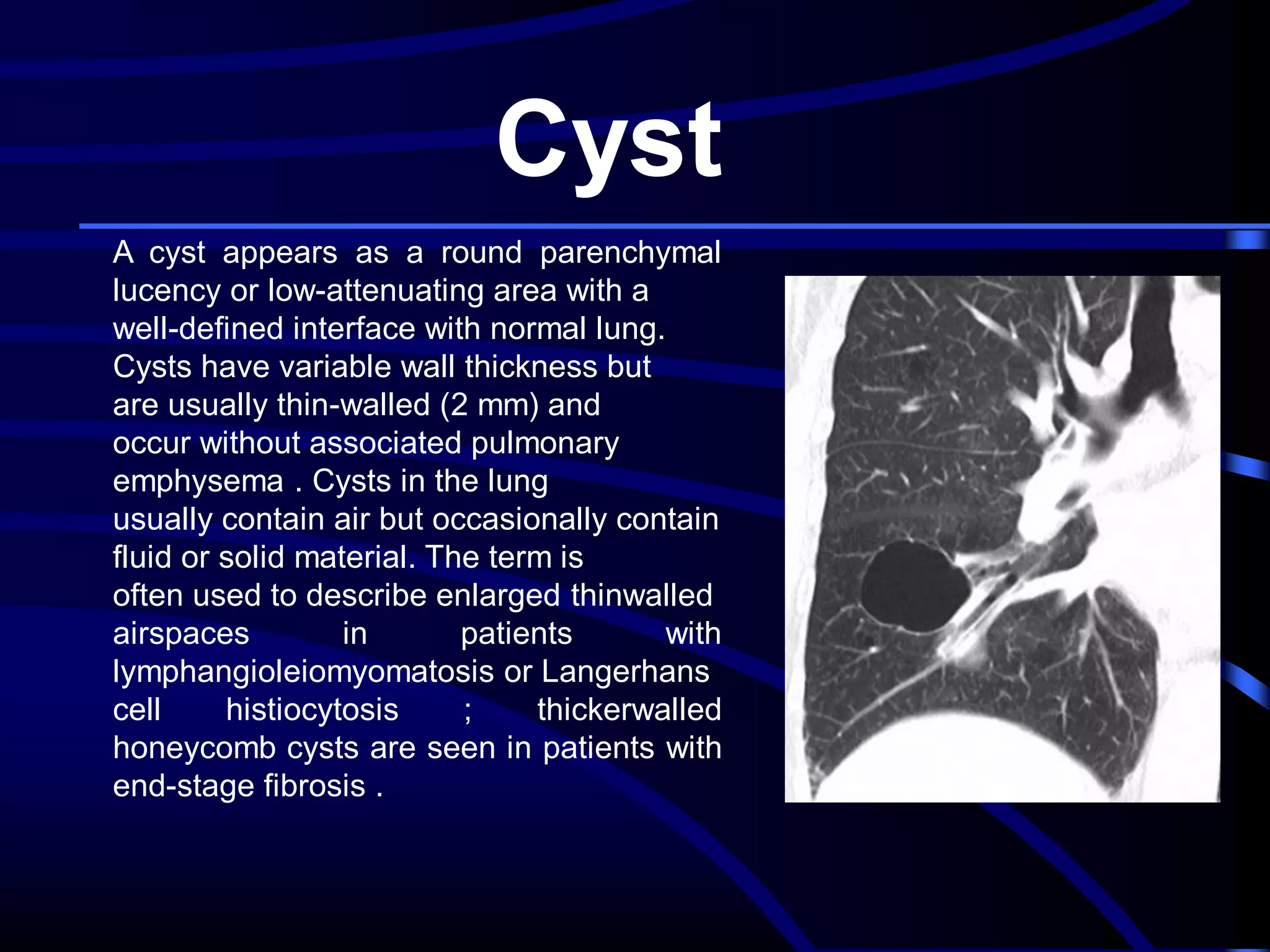 Cyst
A cyst appears as a round parenchymal
lucency or low-attenuating area with a
well-defined interface with normal lung.
Cysts have variable wall thickness but
are usually thin-walled (2 mm) and
occur without associated pulmonary
emphysema . Cysts in the lung
usually contain air but occasionally contain
fluid or solid material. The term is
often used to describe enlarged thinwalled
airspaces
in
patients
with
lymphangioleiomyomatosis or Langerhans
cell
histiocytosis
;
thickerwalled
honeycomb cysts are seen in patients with
end-stage fibrosis .

 