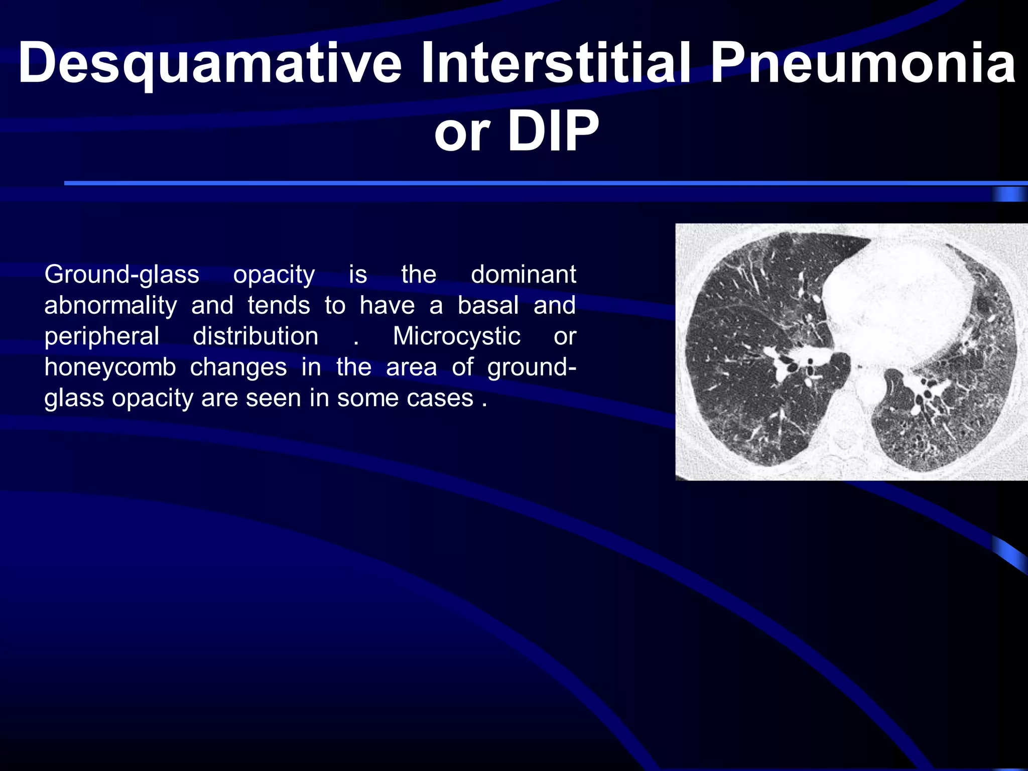Desquamative Interstitial Pneumonia
or DIP
Ground-glass opacity is the dominant
abnormality and tends to have a basal and
peripheral distribution . Microcystic or
honeycomb changes in the area of groundglass opacity are seen in some cases .

 