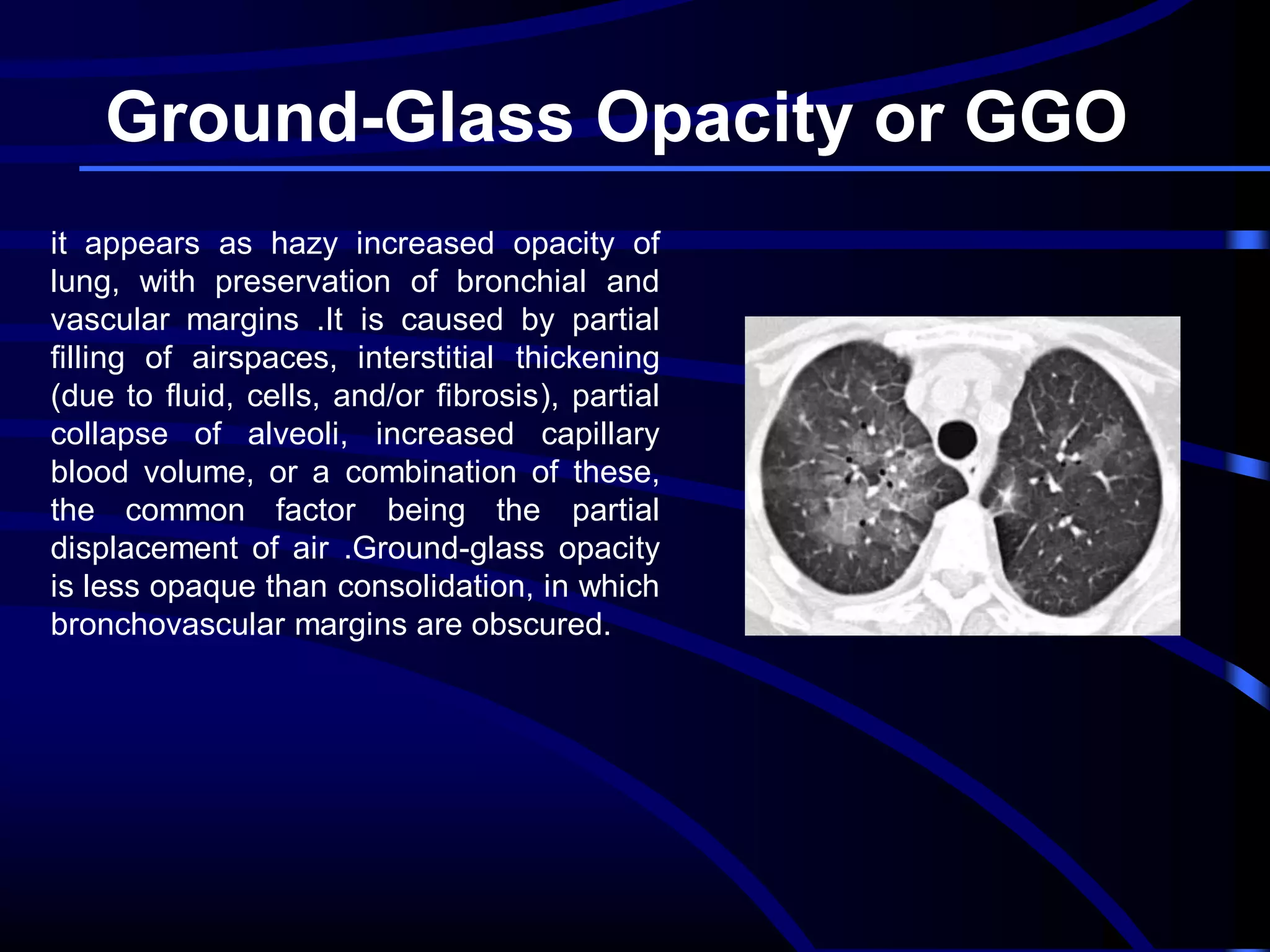 Ground-Glass Opacity or GGO
it appears as hazy increased opacity of
lung, with preservation of bronchial and
vascular margins .It is caused by partial
filling of airspaces, interstitial thickening
(due to fluid, cells, and/or fibrosis), partial
collapse of alveoli, increased capillary
blood volume, or a combination of these,
the common factor being the partial
displacement of air .Ground-glass opacity
is less opaque than consolidation, in which
bronchovascular margins are obscured.

 