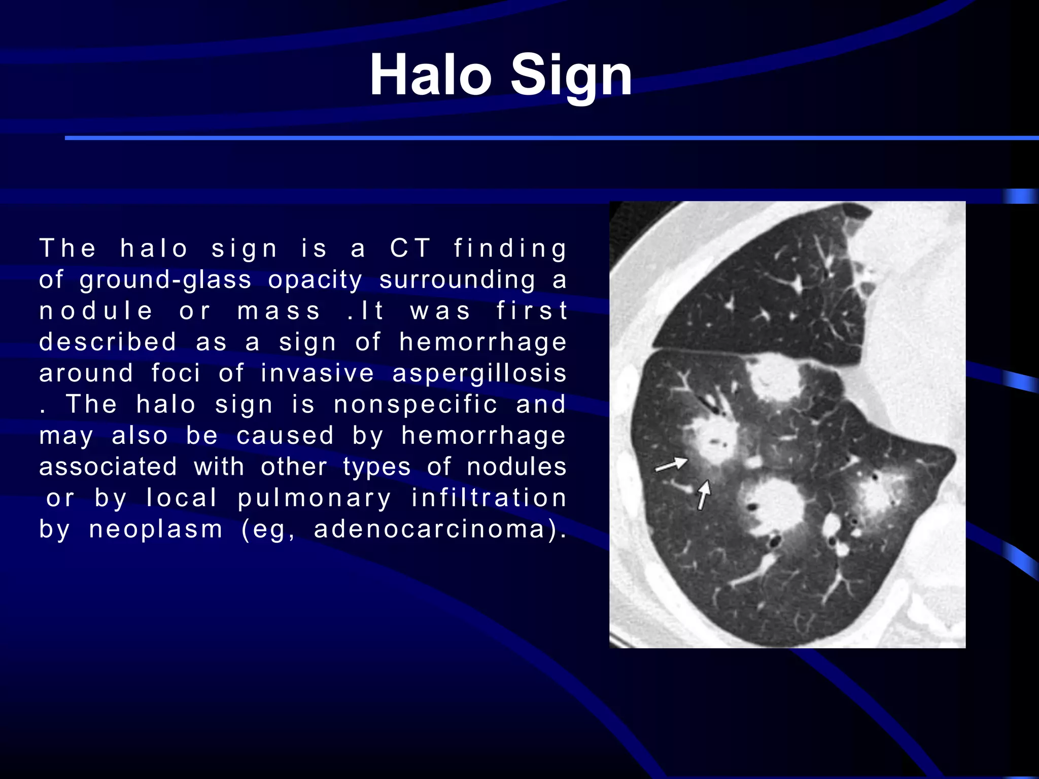 Halo Sign
The halo sign is a CT finding
of ground-glass opacity surrounding a
nodule or mass .It was first
d e s c r i b e d a s a si g n o f h e mo r r h a g e
a r o u n d f o ci o f i n va si ve a sp er g ill o si s
. The halo sign is nonspecific and
ma y a l so b e ca u se d b y h e mo r r h a g e
associated with other types of nodules
o r b y l ocal pul monar y infiltr ation
b y n e o p l a s m ( e g , a d e n o c a r ci n o ma ) .

 