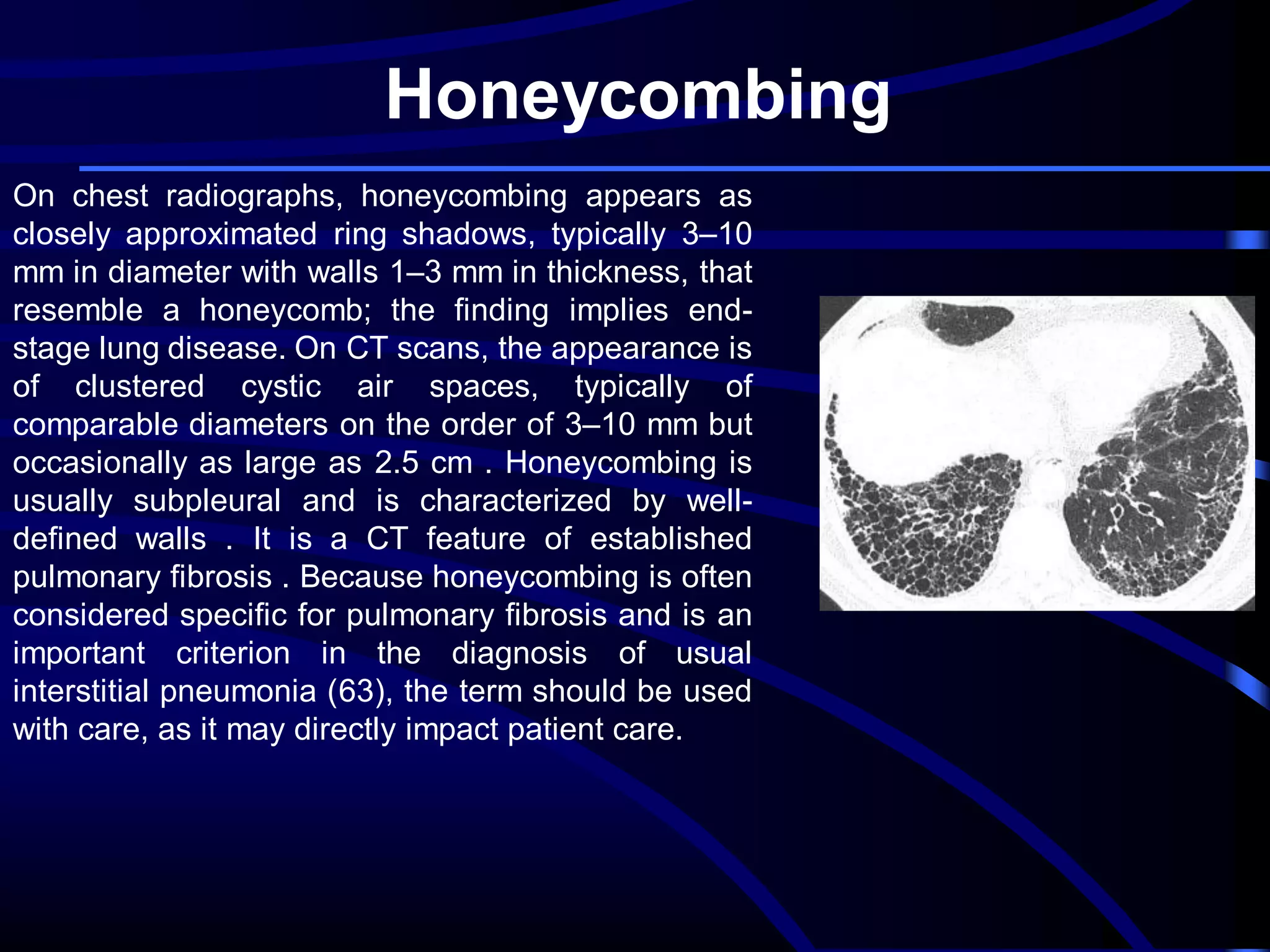 Honeycombing
On chest radiographs, honeycombing appears as
closely approximated ring shadows, typically 3–10
mm in diameter with walls 1–3 mm in thickness, that
resemble a honeycomb; the finding implies endstage lung disease. On CT scans, the appearance is
of clustered cystic air spaces, typically of
comparable diameters on the order of 3–10 mm but
occasionally as large as 2.5 cm . Honeycombing is
usually subpleural and is characterized by welldefined walls . It is a CT feature of established
pulmonary fibrosis . Because honeycombing is often
considered specific for pulmonary fibrosis and is an
important criterion in the diagnosis of usual
interstitial pneumonia (63), the term should be used
with care, as it may directly impact patient care.

 